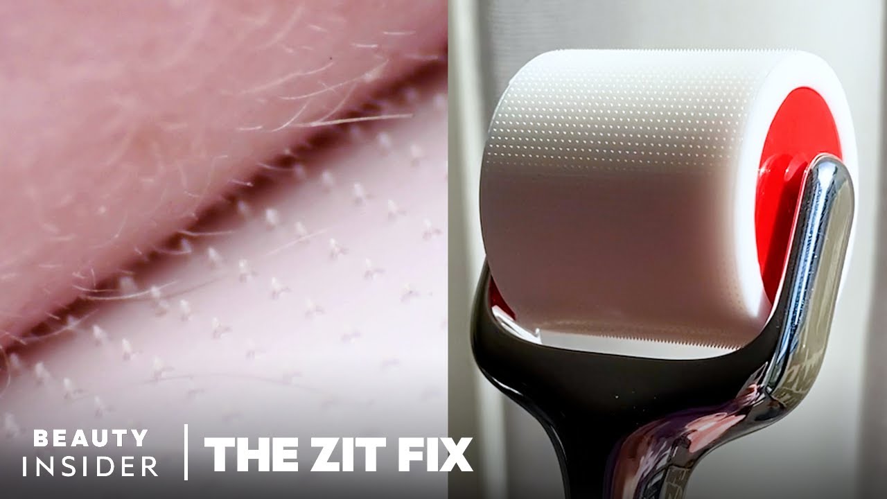 Microneedle Tool Has 3,000 Dissolving Needles, Which Improve Appearance Of Skin | The Zit Fix