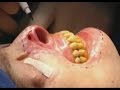 Face Transplant Before and After