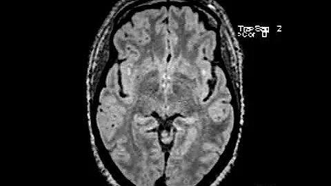 White matter disease associated with migraine headaches