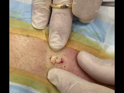 It's A St. Paddy's Day Back Cyst! Part 1