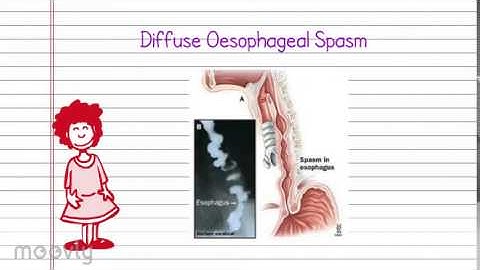 Diffuse Oesophageal Spasm