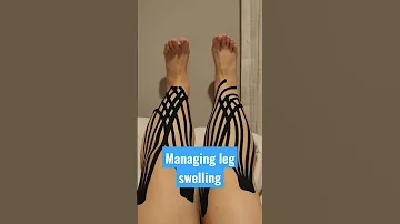 How To Treat Leg Swelling In 3 Steps 
