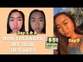 THIS CLEARED MY ACNE IN 3 DAYS | ACTUALLY WORKED!