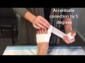 Bunion Taping Video