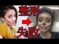 衝撃過ぎる整形大失敗5選!!失敗してからでは遅い!!