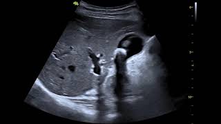 gallstone on ultrasound