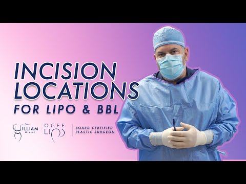 Incision Locations for LIPO and BBL