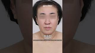 얼굴리프팅, 오래 유지하고 싶다면?💕 자연스럽게 어려지는 안면거상의 힘