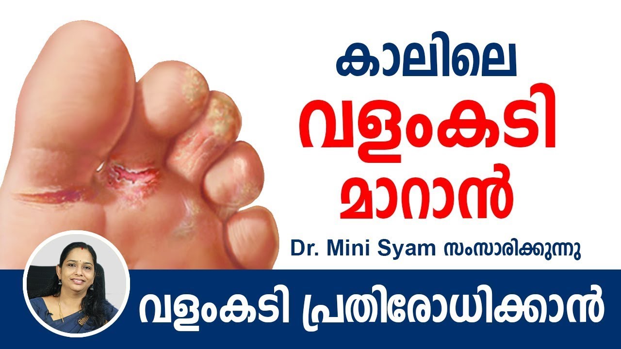 കാലിലെ വളംകടി മാറാൻ Malayalam Health Tips