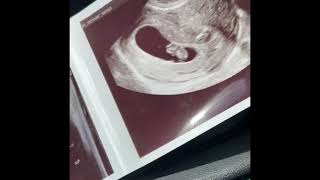 Aaron Carter First Baby Ultrasound Photo‘s 