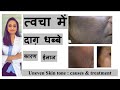 त्वचा में दाग़ धब्बे। How to improve Uneven  skin tone | Hindi |Causes & treatment| Dr.Aanchal Panth