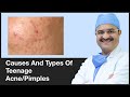 Causes And Types Of Teenage Acne/Pimples | ClearSkin, Pune | (In HINDI)