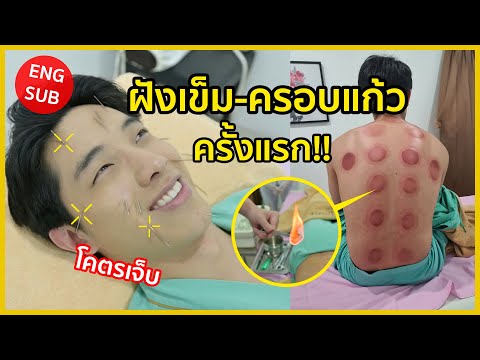 ฝังเข็ม-ครอบแก้วครั้งแรกในชีวิต!! ฝังเข็ม 50 เล่ม จะทนไหวไหม?! | KAYAVINE