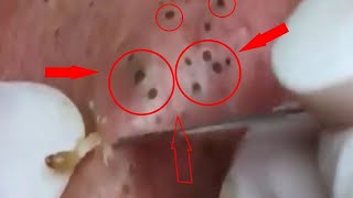 Blackheads & Milia, Big Cystic Acne Blackheads Extraction Whiteheads Removal Pimple Popping EP00#N5