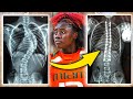 Ja’Leah Williams Scoliosis Surgery: Spine Surgeon Explains