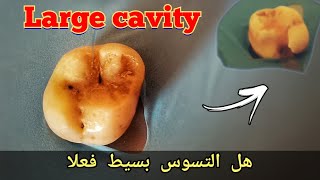 هل هذا التسوس بسيط حقا؟ لا تتسرع في الحكم hidden huge caries