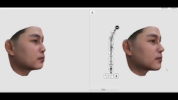Trải Nghiệm Mô Phỏng 3D Trước Phẫu Thuật Thẩm Mỹ Tại Bệnh Viện Thẩm Mỹ Việt Mỹ