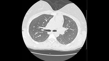 Nonspecific interstitial pneumonia (NSIP): multiple examples with typical imaging patterns