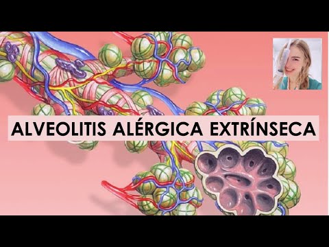 Vídeo: Alveolitis Alérgica Exógena: Guías Clínicas, Información General