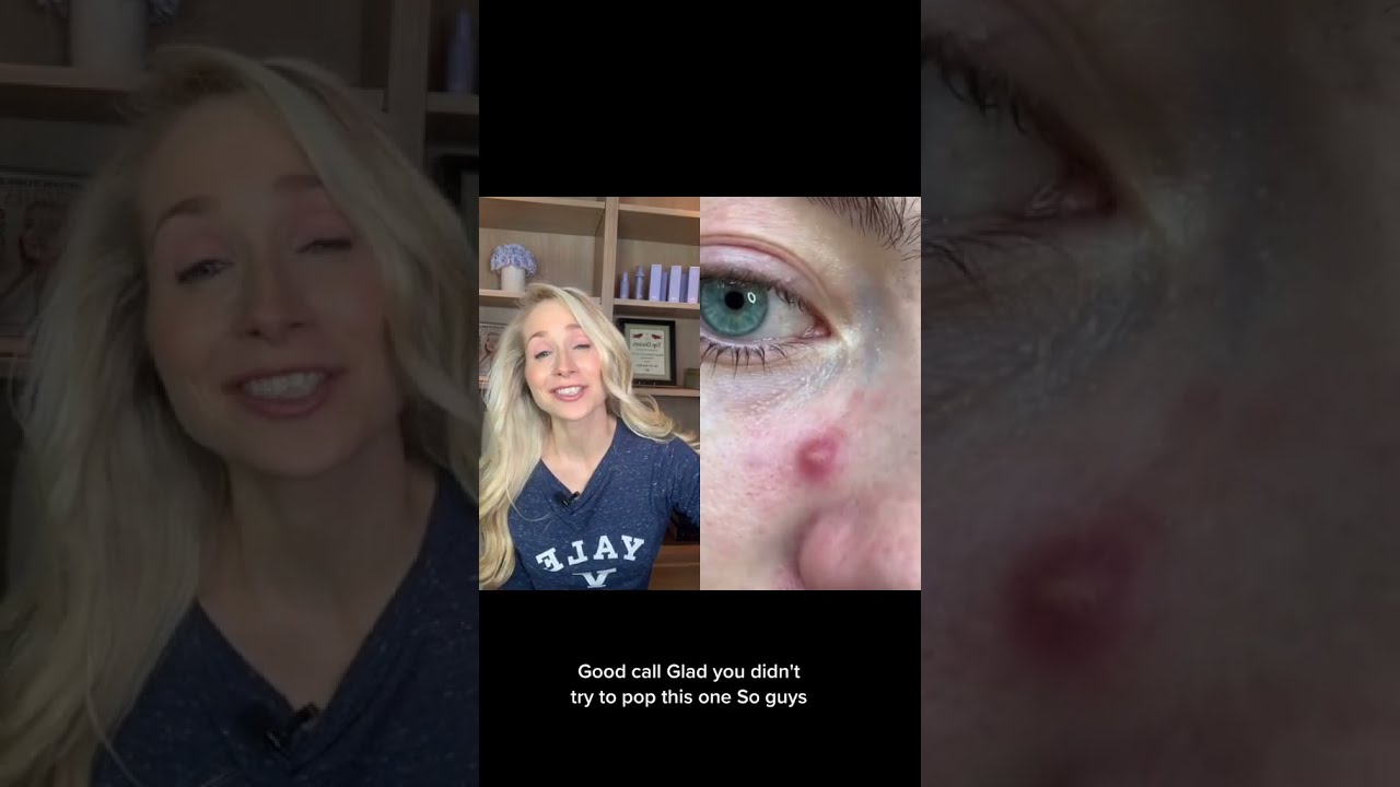 Dermatologist On Pimple Patch Removal Shorts