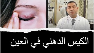 الكيس الدهني في العين (الاسباب والوقايه والعلاج)