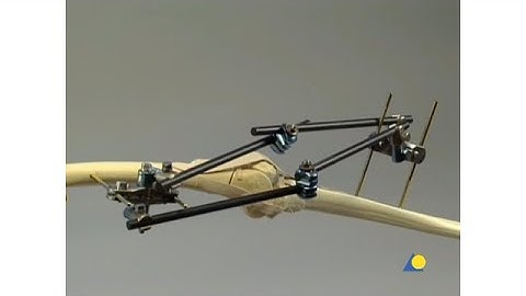 Femur, Tibia - Articular Fracture- Large External Fixator- Knee-Bridging Frame with Multi-Pin Clamps