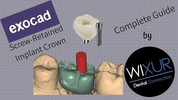 Exocad - Screw-Retained Implant Crown