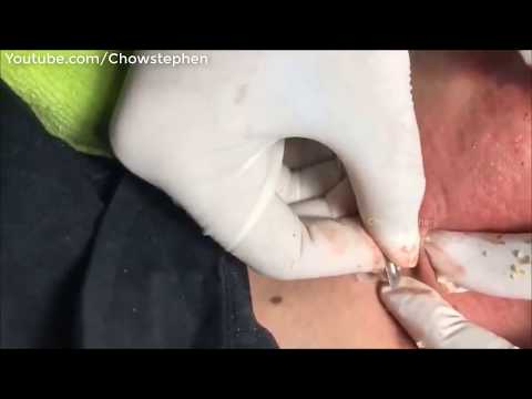 A lot Of Blackheads On Neck & Face Extraction - Cyst Acne Behind Ear Removal