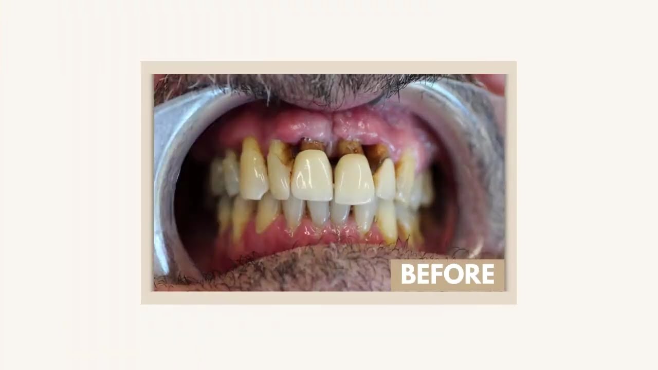 Full Mouth Dental Implants: Everything You Need to Know | Angela Leung DDS PC