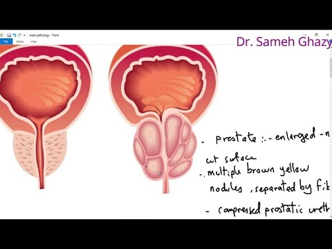 systemic pathology 58 : male genital system 2  ( senile prostatic hyperplasia ) تضخم البروستاتا