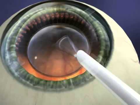 PIOL Surgery (Phakic IOL) การใส่เลนส์เสริม ทางเลือกสำหรับผู้ที่ปัญหาสายตาสั้นและเอียงมาก