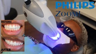 Philips Zoom! Professional Teeth Whitening *SAME DAY RESULTS* | HYGIENIUS EP. 4