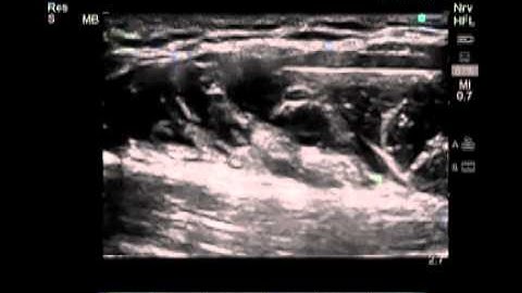 How To: Ultrasound-Guided Axillary Brachial Plexus Nerve Block Scanning Technique Video