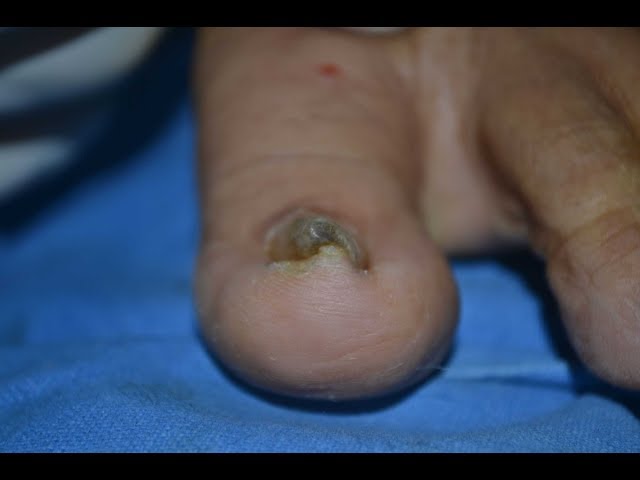 Pincer nail deformity — Steemit