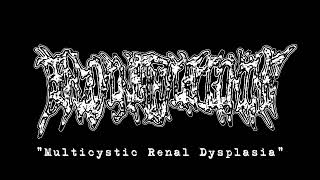 Benzoylmethylecgonine - Multicystic Renal Dysplasia