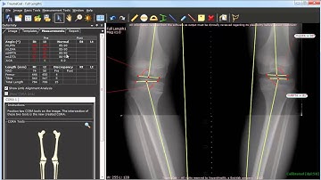 Deformity Correction Planning