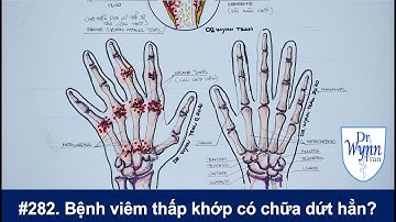 # 282. Viêm thấp khớp có thể chữa dứt hẳn? Cập nhật chẩn đoán và chữa trị