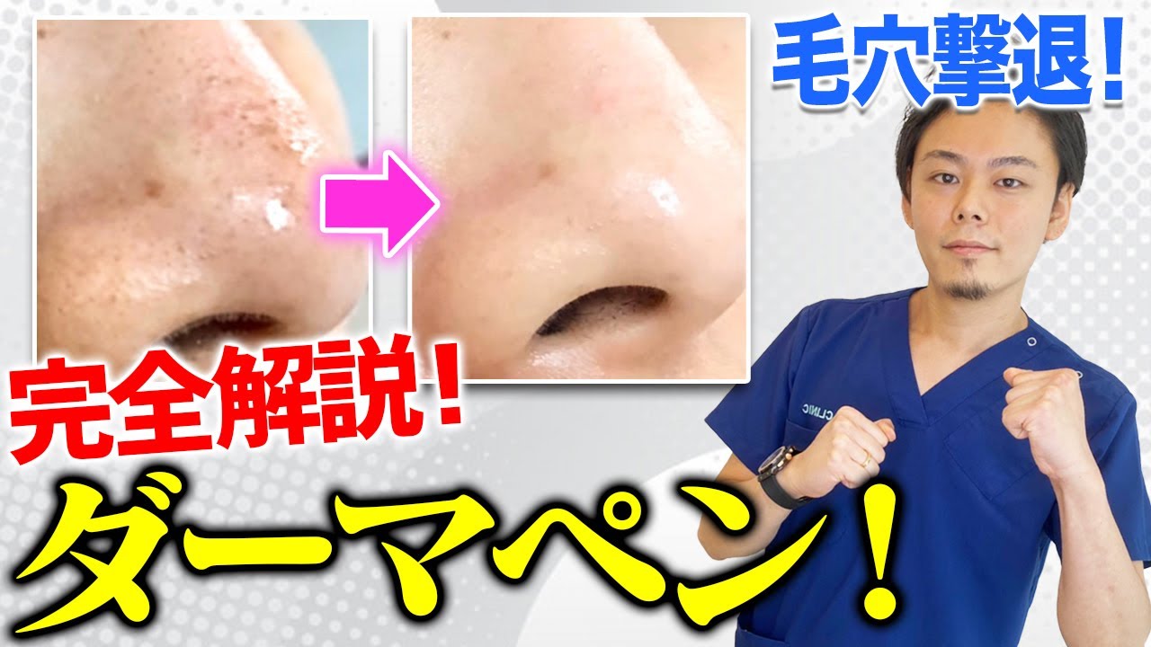 【毛穴をなくす】毛穴の開き ・ たるみ毛穴を確実に治す！ダーマペンの効果紹介【 ニキビ跡 にも効く？】 - YouTube