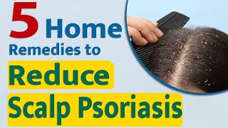 5 best home remedies to reduce Scalp Psoriasis | Bharat Homeopathy