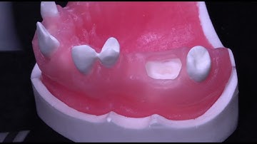 Watch Ridge Preservation Suturing by Dr. Brian Goodacre