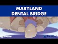 MARYLAND bridge - A DENTAL BRIDGE alternative for missing teeth ©