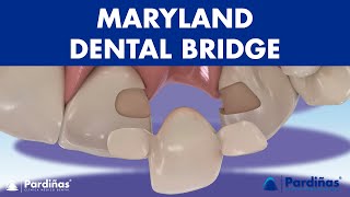 MARYLAND bridge  A DENTAL BRIDGE alternative for missing teeth ©