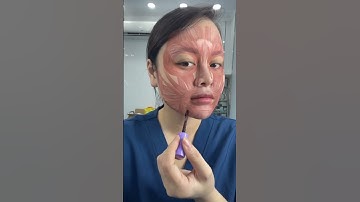 Xác định điểm tiêm nâng khoé miệng