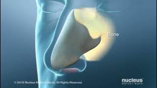 Deviated Septum Surgery (Septoplasty) for Difficulty in Breathing