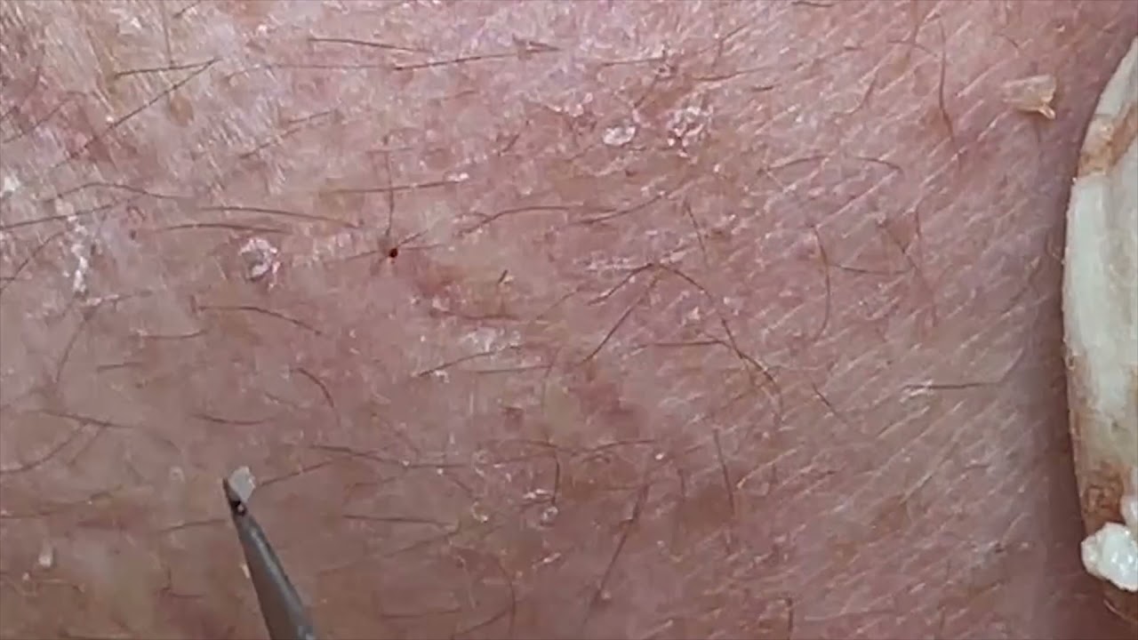 399 Blackheads & Acne treatment 21/10/2021 YouTube