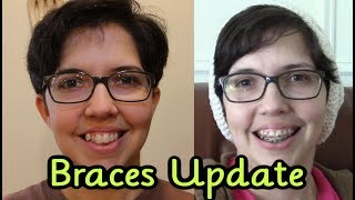 Adult Braces Update (Month 1-4)