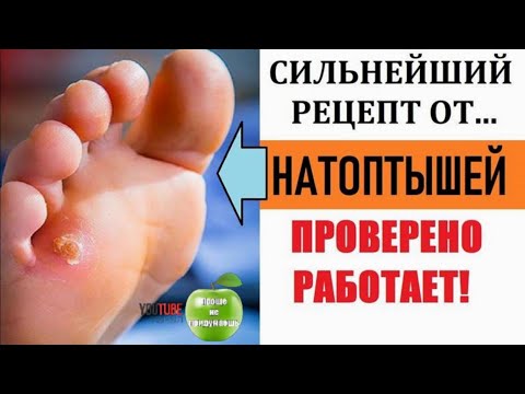 Как избавиться от натоптышей -  Эффективный и Абсолютно бюджетный рецепт.