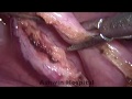 Lap appendectomy step by step with voice over