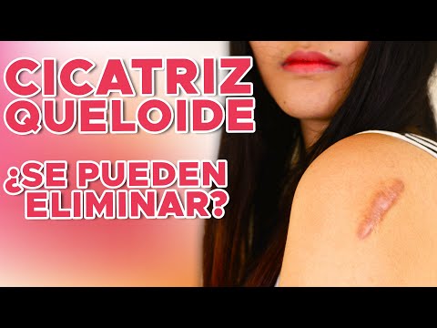 Vídeo: Cicatrización De Tatuajes: ¿Puedo Tratar O Eliminar Cicatrices De Tatuajes No Deseadas?