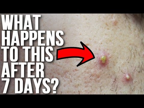 Don&#;t Touch Your Acne & See What Happens!